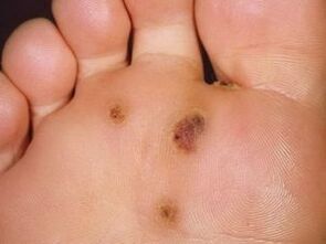 How to get rid of a plantar wart