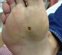Ways to remove warts on the sole of the legs