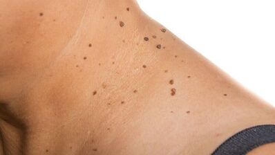 How to get rid of the papilloma around the neck