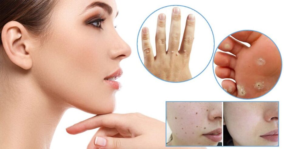 Papilloma removal methods