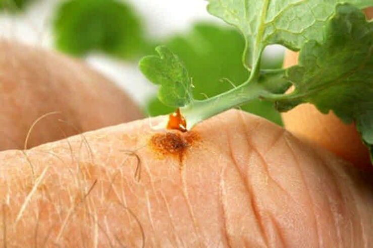 How to remove papillomas with popular medicines