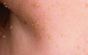 The reasons for the appearance of papillomas in the body