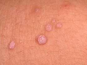 how to get rid of papillomas on the body