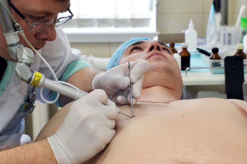 how to get rid of warts on the body