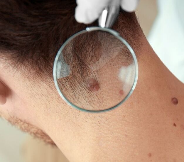 A doctor examines a papilloma on the neck