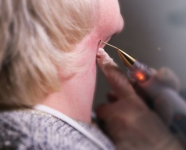 The process of removing papilloma on a woman's neck