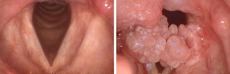 clear throat and pharyngeal papillomas