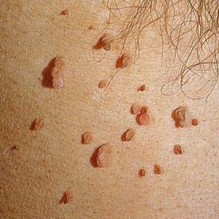 Papillomas usually grow in colonies and can appear on the skin all over the body. 